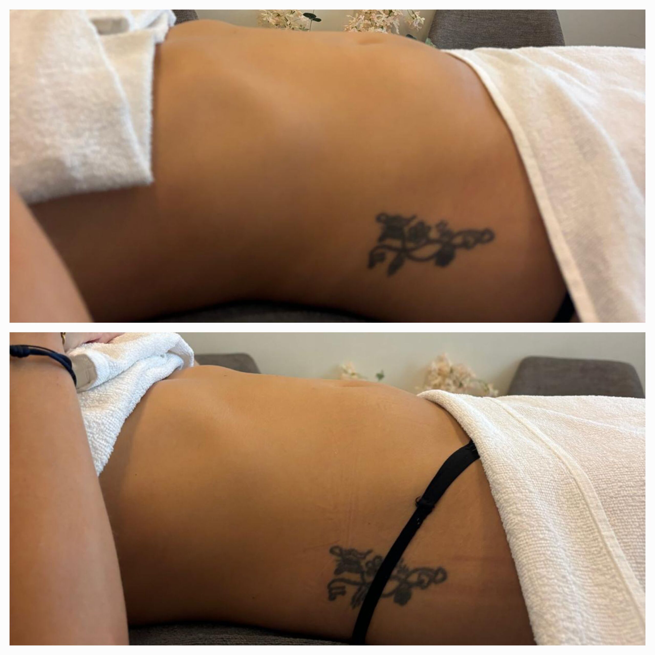 Brazilian Lymfe Drainage Massage - voor en na